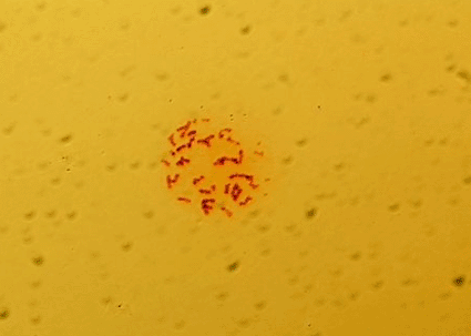 Image: Light micrograph of the chromosomes of a person with fragile X syndrome, a genetic cause of mental retardation (Photo courtesy of CMSP/SPL).